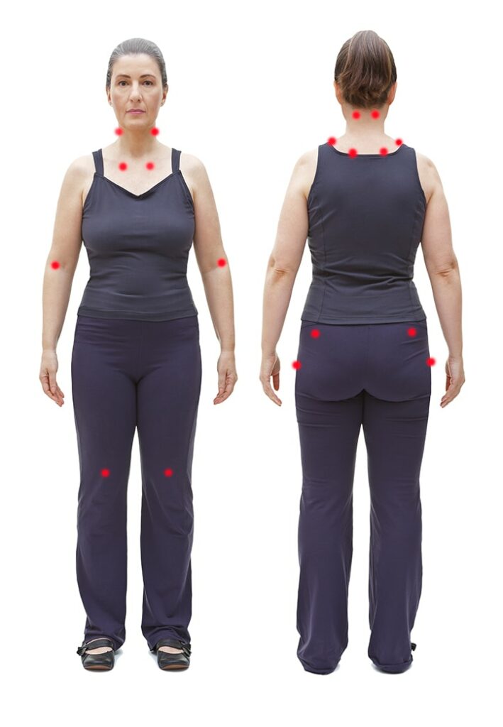 Fibromyalgie